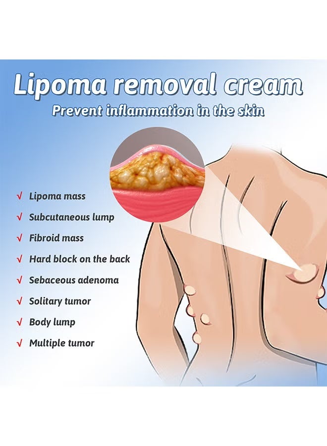South Moon Lipoma Removal Cream, Underarm And Neck Lymphatic Care Cream, Lymphatic Drainage Cream, Anti-Cellulite Remover Cream, For Lipolysis Fat Lump Removal And Nodular Discomfort For Body And Face 50G - Image 2
